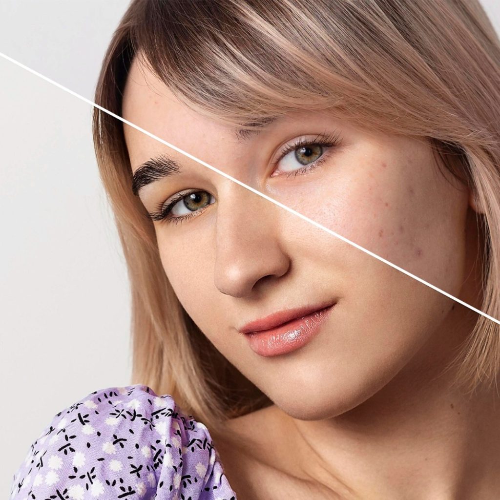 مقارنة بين بشرة الوجه قبل وبعد جلسات الليزر للبشرة، تُظهر تحسن الملمس والنقاء بعد العلاج التجميلي